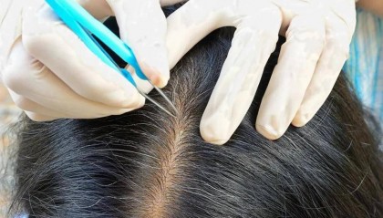 白头发拔一根长三根？到底能不能拔？终于弄清楚了