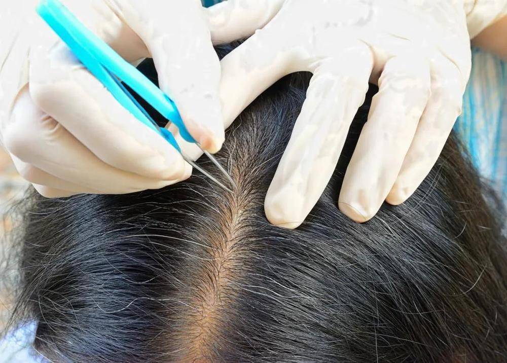 白头发拔一根长三根?到底能不能拔?终于弄清楚了